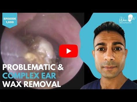 314 1 000 Problematic Complex Ear Wax Removal YouTube Impacted