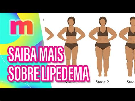 Entenda Tudo Sobre Lipedema Mulheres Youtube