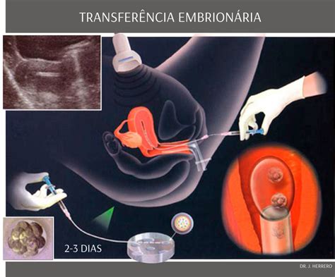 Tratamentos FertilizaÇÃo In Vitro Icsi Monteleone Centro De