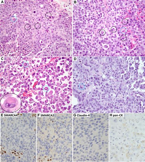 Smarca4 Deficient Thoracic Sarcomatoid Tumors Represent Primarily Smoking Related