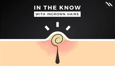 Ingrown Hairs And Waxing What You Can And Cannot Control Nova Wax