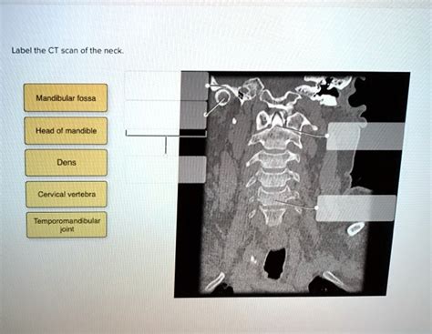 Solved Label The Ct Scan Of The Neck Mandibular Fossa Head Of Mandible