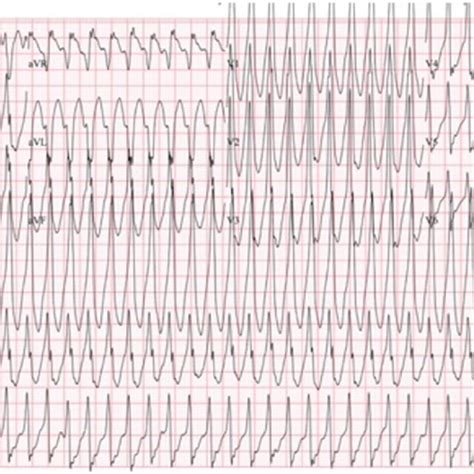 Initial Ecg In The Ed Showing Ventricular Tachycardia Download