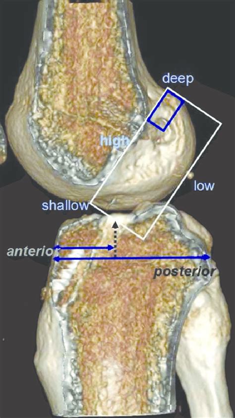 Measurements Of The Centres Of The Femoral Tunnel And Tibial Tunnel On