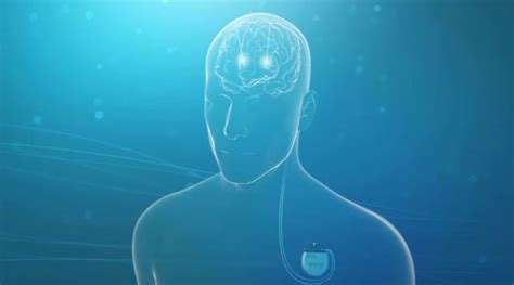 Boston Scientific Receives U S Fda Approval For The Vercise™ Deep Brain Stimula