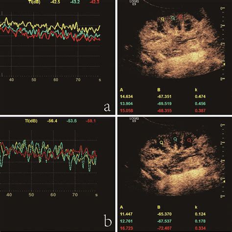 Quantitative Analysis Of Contrast Enhanced Ultrasonography CEUS