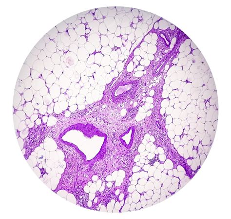 Premium Photo | Photomicrograph of granulomatous tissue histology ...