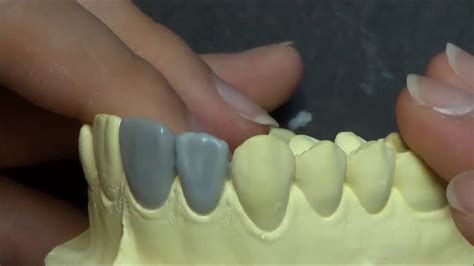 Live Wax Up Upper Lateral Incisor Youtube