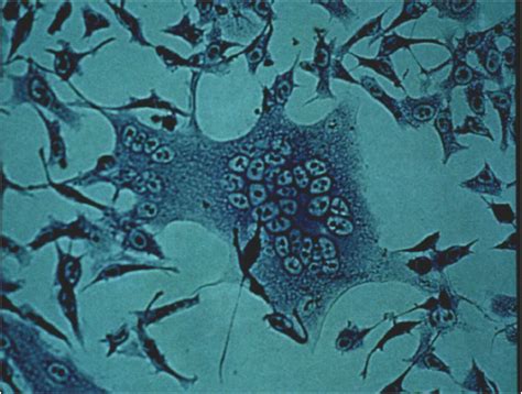 Pathogenicity - MORBILLIVIRUS/MEASLES VIRUS