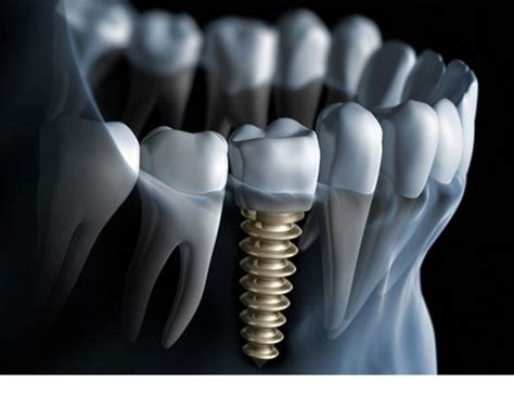 Blog Best Dental Immediate Loading Implants And Treatment In India