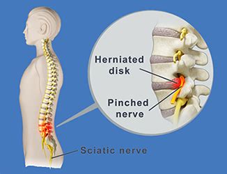 Pinched Nerve | #1 Spine Center | Boca Raton Spine Center