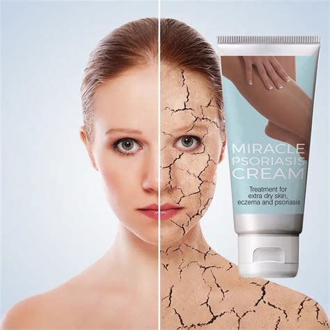 Psoriasis Cream Healthy For Life