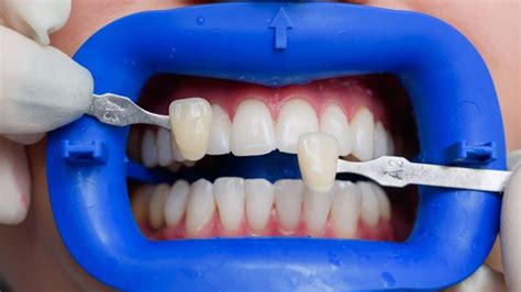 Faceta De Resina Valor Por Dente Antes E Depois E Desvantagens