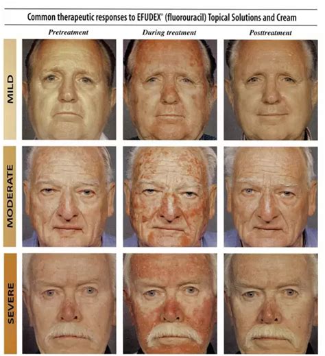 sun damage warning skin cancer awareness