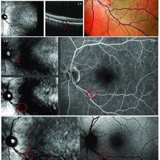 Multimodal Imaging Of Drusen Using Nidek Mirante Retro Mode