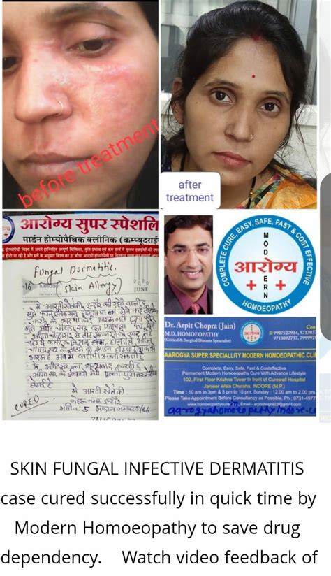 Fungal Infection Treatment Homeopathy In Hindi At David Snider Blog