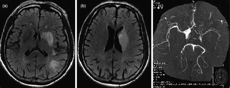 Ct And Mr Findings In Hiv Negative Neurosyphilis European Journal Of