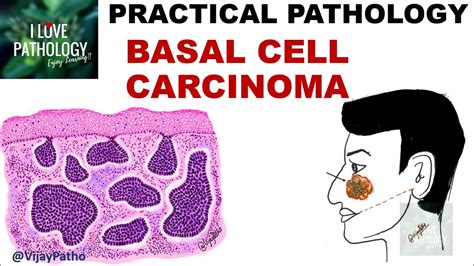 Basal Cell Carcinoma Clinical Features Morphology Youtube