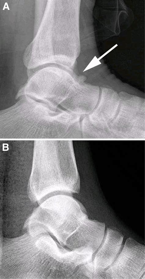 Osteophytes Ankle