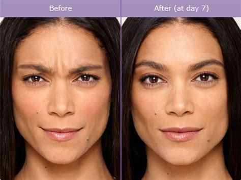 Botox Injectable Brow Forehead Lift Atlanta Georgia Buckhead