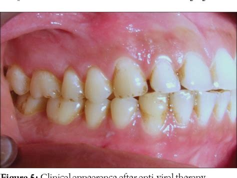 Herpetic Gingivostomatitis Gums