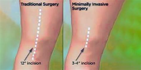 Minimally Invasive Knee Replacement Surgery - Pristyn Care