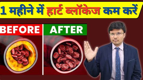 Foods To Unclog Your Arteries And Keep Your Heart Healthy I Dr Navin