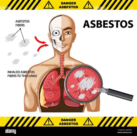 Diagram Showing Asbestosis In Lungs Illustration Stock Vector Image