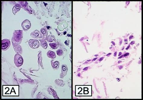 Diagnostic Value Feasibility And Validity Of Preparing Cell Blocks