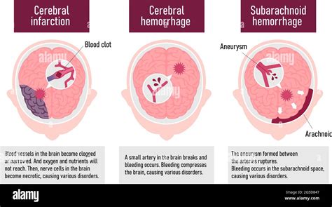 Types Of Human Brain Stroke Vector Illustration Stock Vector Image