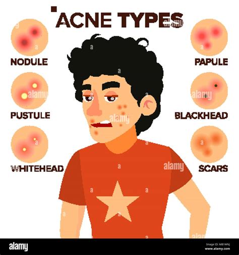 Acne Types Vector Boy With Acne Pimples Wrinkles Dry Skin