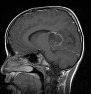 Pilocytic Astrocytoma- MRI Findings - Sumer's Radiology Blog