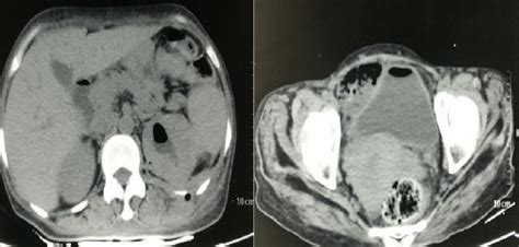 Grade I Emphysematous Pyelonephritis With Emphysematous Cystitis Download Scientific Diagram