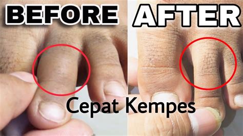 Cara Mengatasi Jari Kaki Bengkak 🔴 Kaki Keseleo Langsung Sembuh ⁉️ Youtube