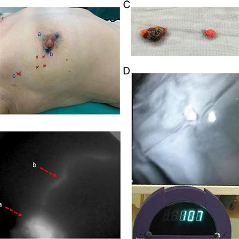 Operation Time Learning Curve Of Sentinel Lymph Node Biopsy SLNB With