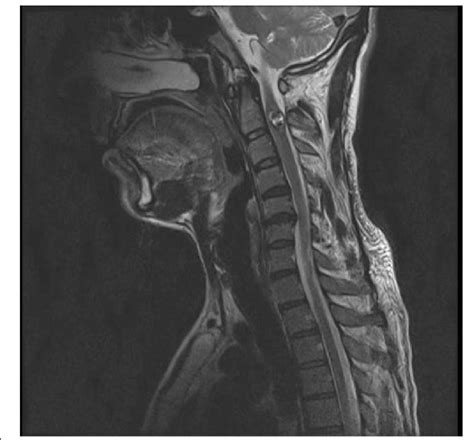 MRI of the patient showing cavernoma | Download Scientific Diagram