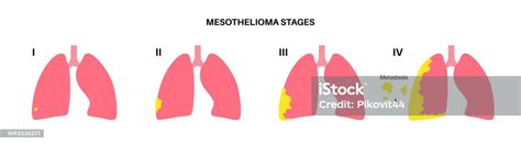 Mesothelioma Cancer Stages Stock Illustration Download Image Now