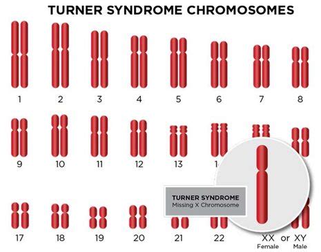 Monosomy X (Turner Syndrome): Diagnosis & Treatment | SSM Health