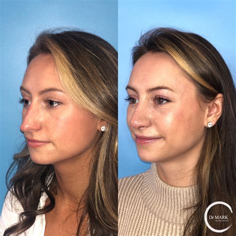 Rhinoplasty Before And After Images Dr Markarian