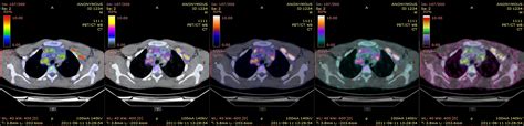 Image Fusion PET CT