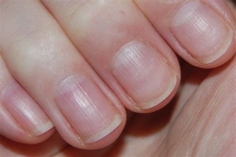 Ridged Nails Heres Why And How To Treat Them Scratch