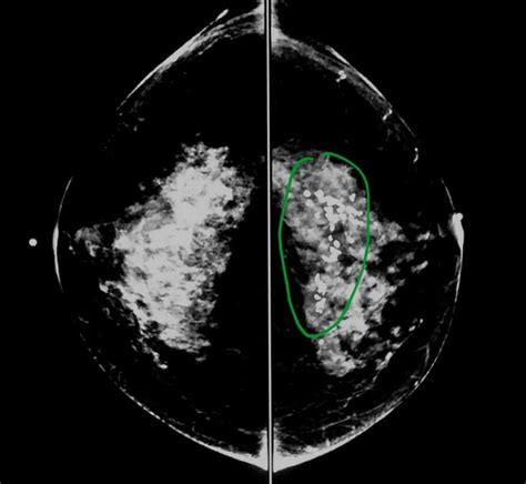 Clear mammogram image showing benign calcifications