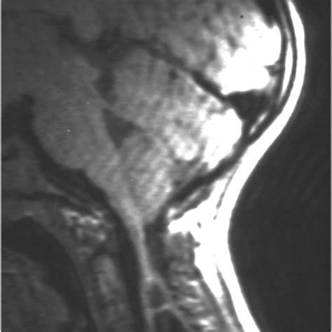 Minimal descent of the cerebellar tonsils but in this patient, there ...