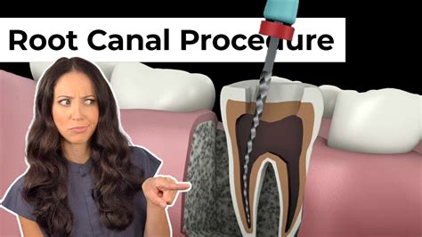 Root Canal Procedure Step By Step Youtube