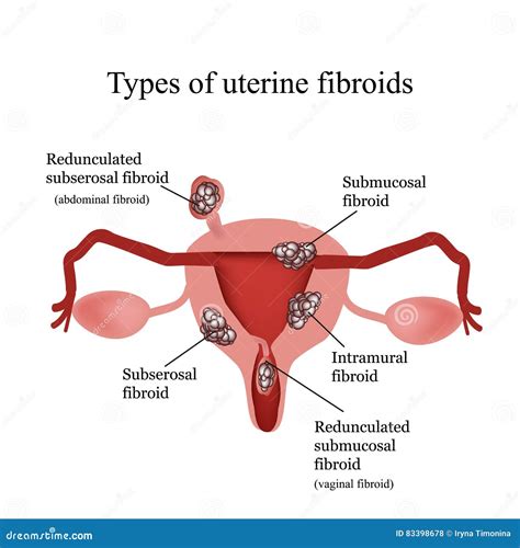 Types Of Uterine Fibroids Endometriosis Infographics Stock Vector