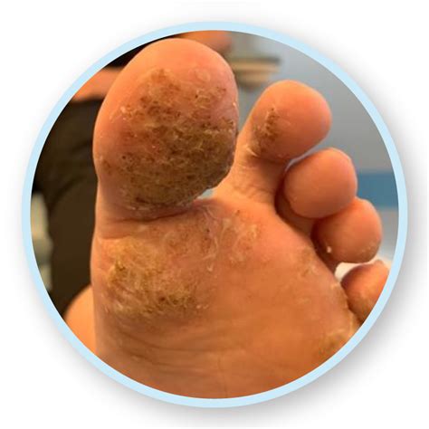 Swift Microwave Therapy Next Step Podiatry And Healthcare