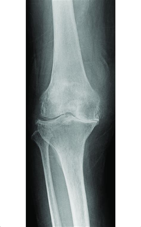 Anterior Posterior Frontal View Of Right Knee Radiograph Calcium