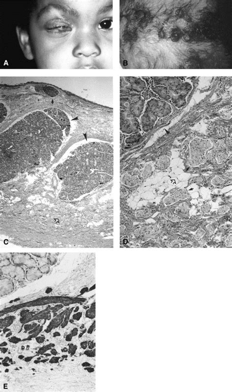 Complex Limbal Choristomas In Linear Nevus Sebaceous Syndrome