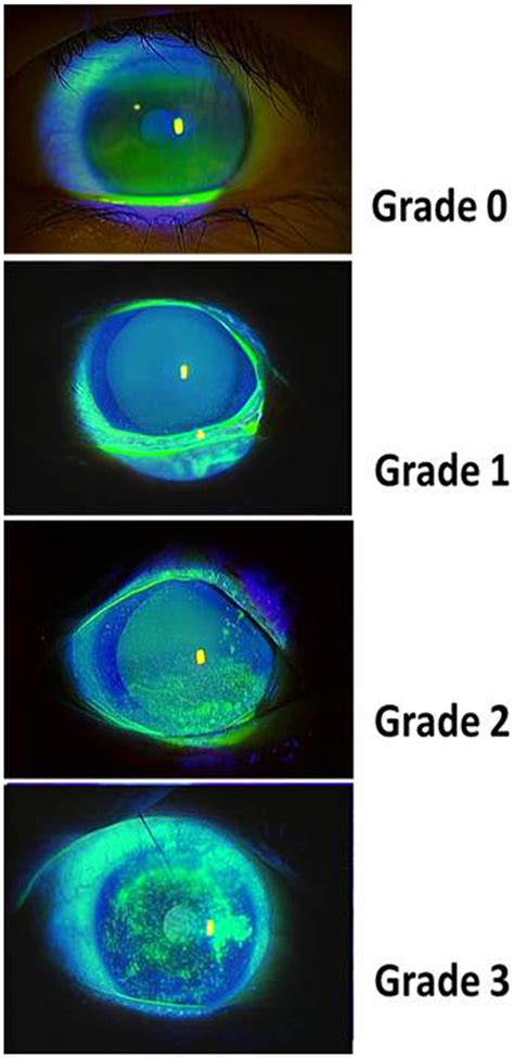 Corneal Spk Staining