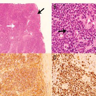 Histopathology Images Of A Plasmablastic Myeloma In The Oral Mucosa A